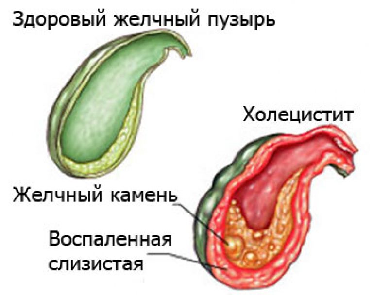 воспаление желчного пузыря симптомы и лечение